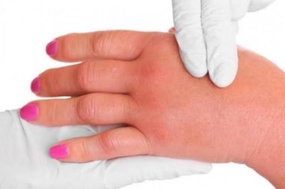 El ve Parmakların şişme nedeni nedir?